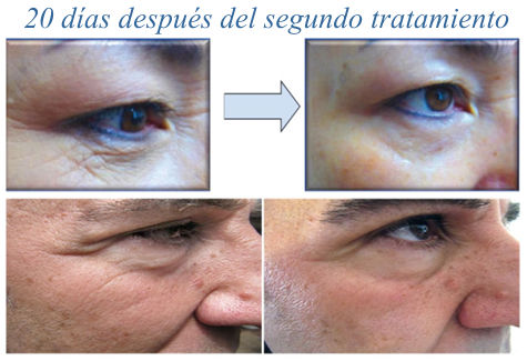 El Nuevo Gel CollaJam (tm) estimula la reorganización de colágeno